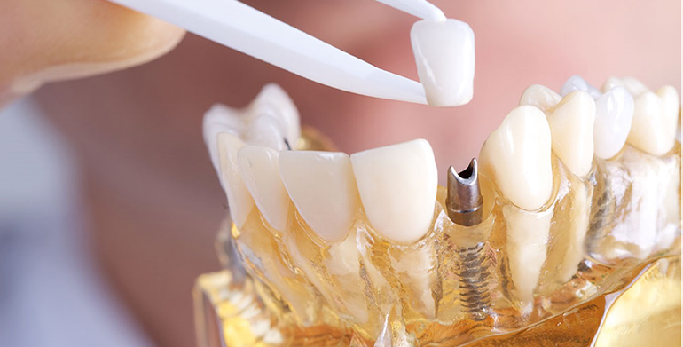 dental-implant-sonrası