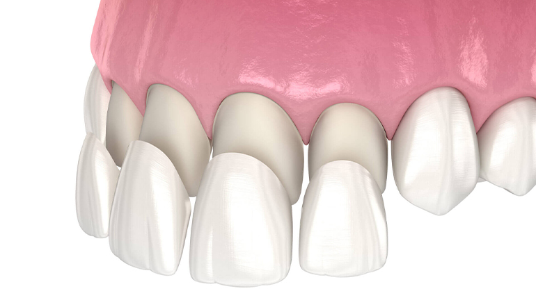 Porcelain veneers in Turkey