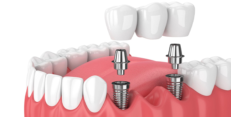 Как устанавливается зубной имплантат