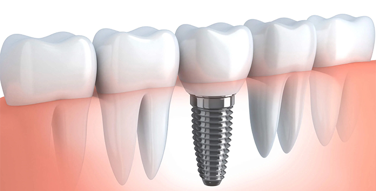 Каковы преимущества зубных имплантатов